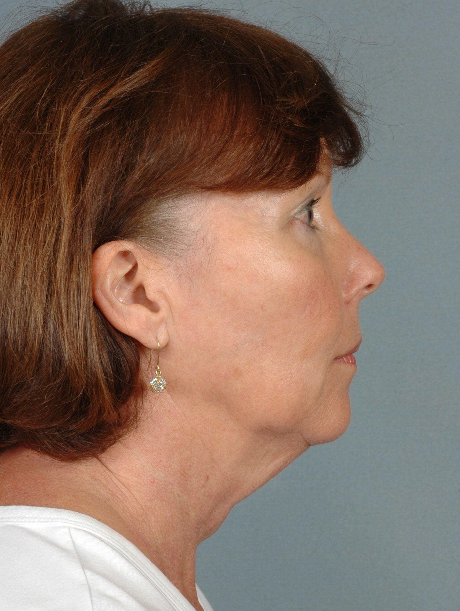 Facelift Patient Photo - Case 15356 - before view-2