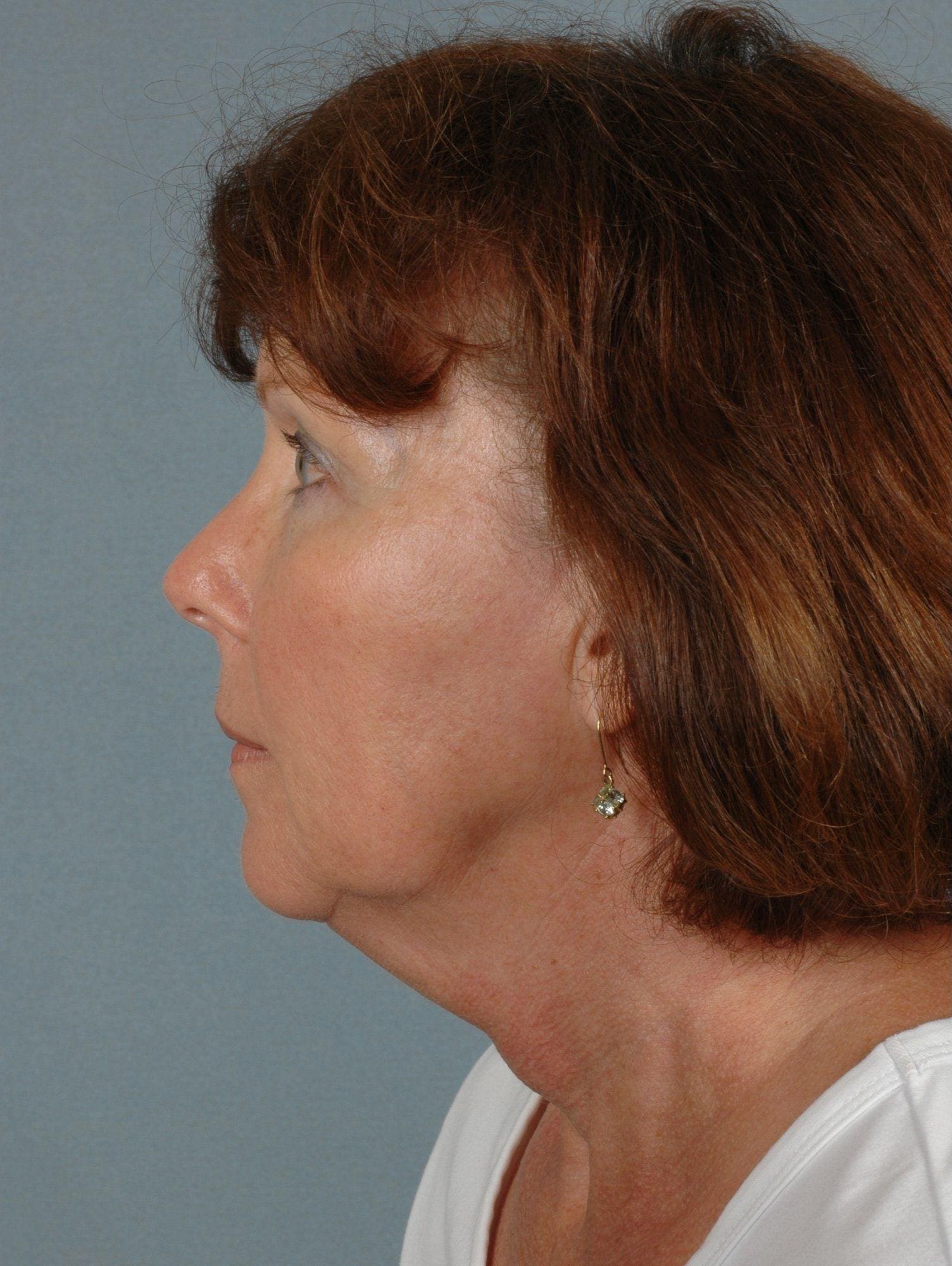 Facelift Patient Photo - Case 15356 - before view-1