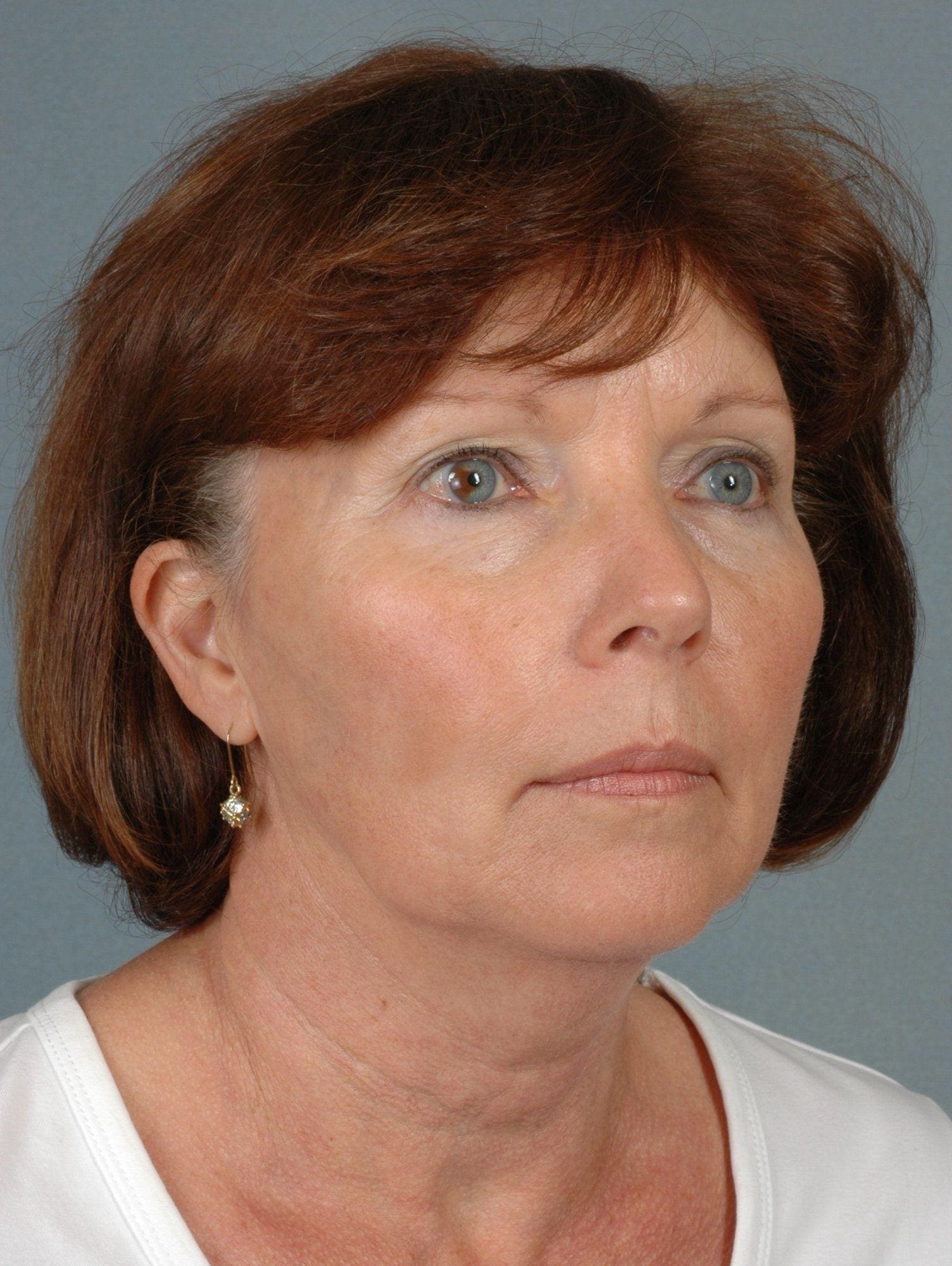 Facelift Patient Photo - Case 15356 - before view-4