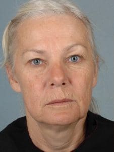 Facelift - Case 15368 - Before