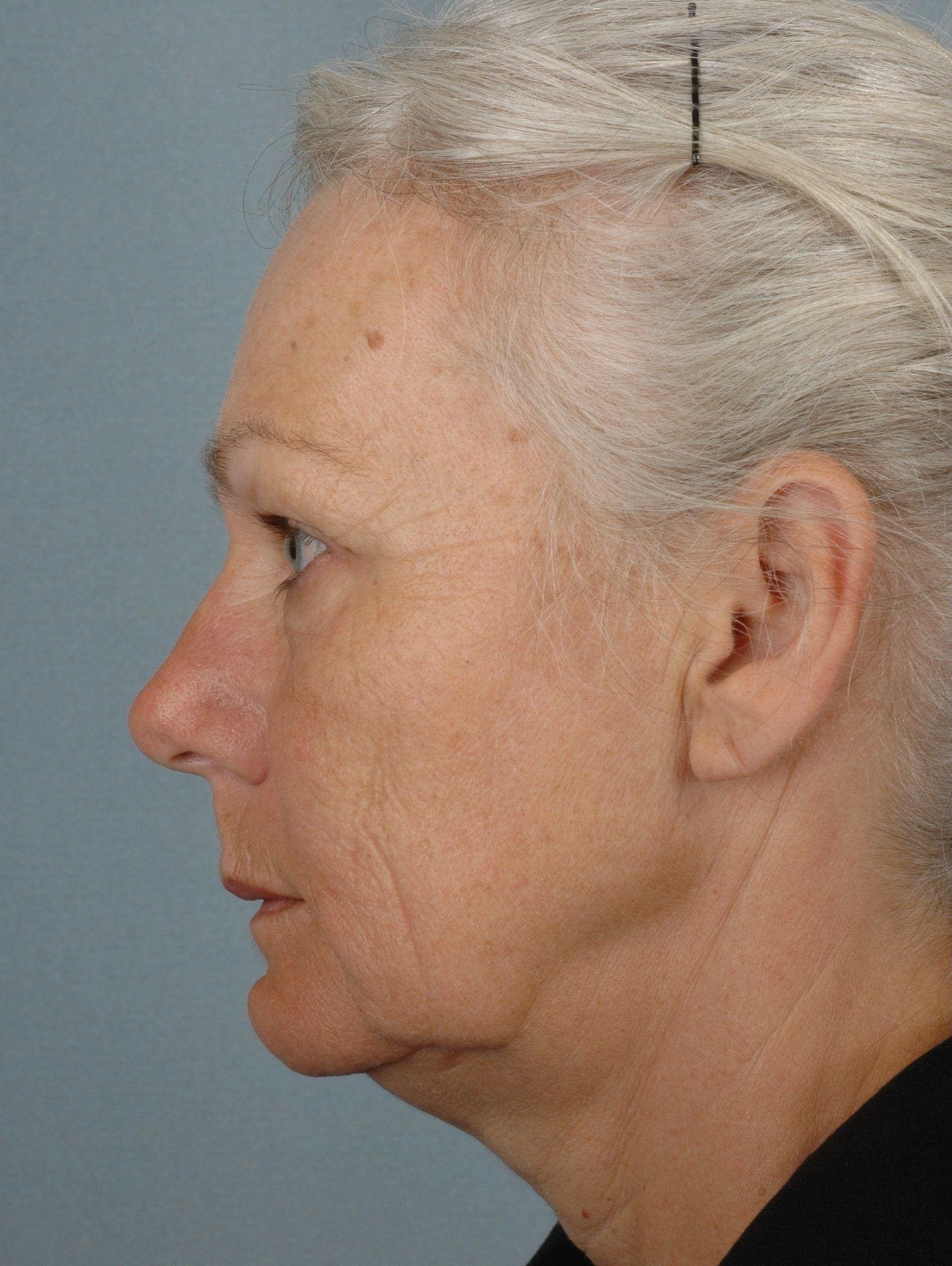 Facelift Patient Photo - Case 15368 - before view-1