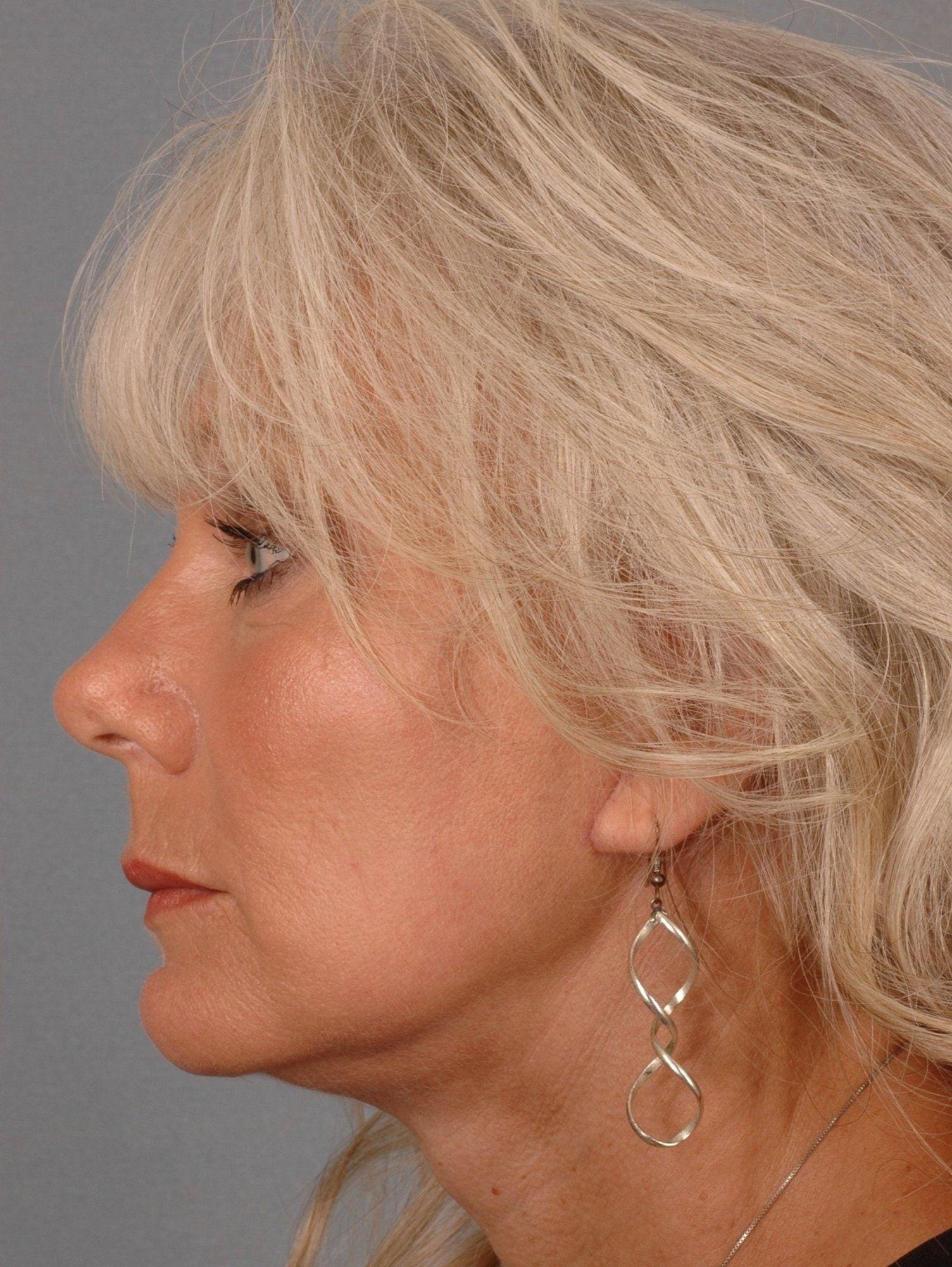 Facelift Patient Photo - Case 15368 - after view-1