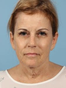 Facelift - Case 15393 - Before