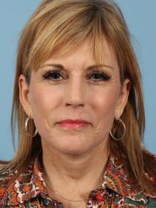 Facelift - Case 15393 - After