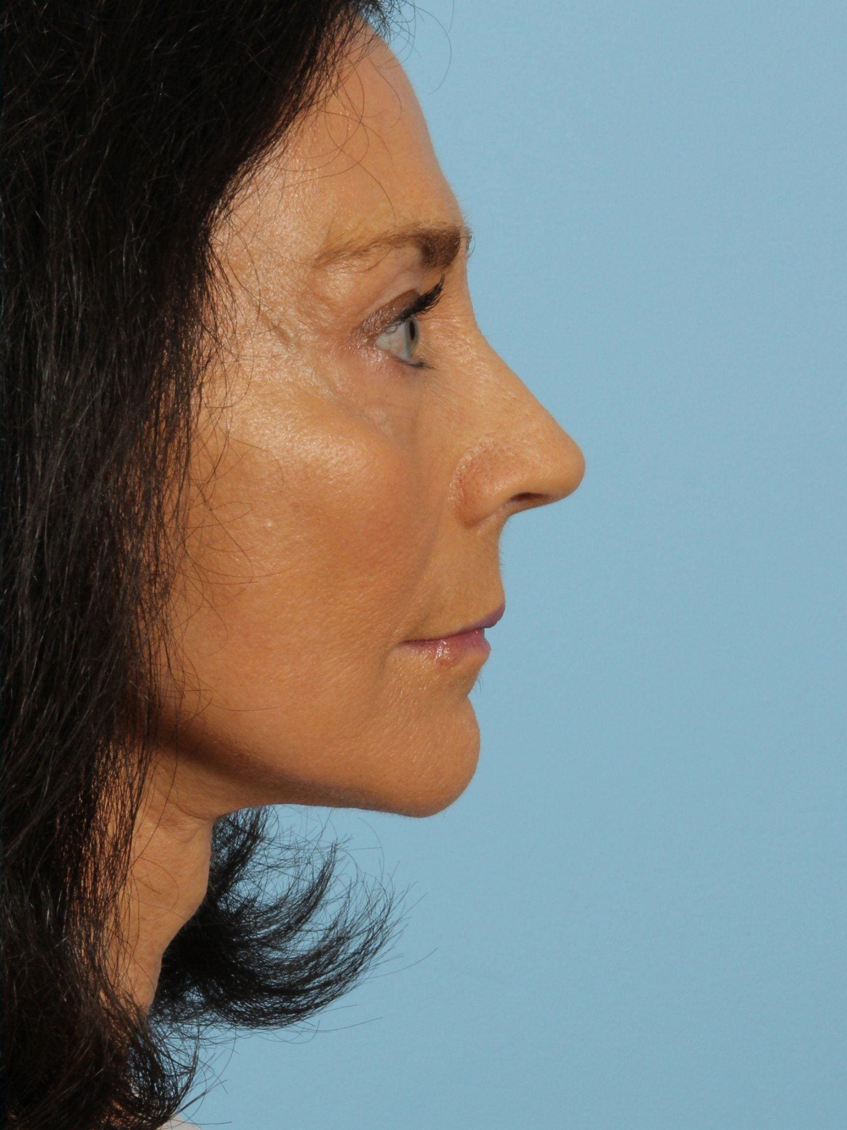 Facelift Patient Photo - Case 15397 - after view-1