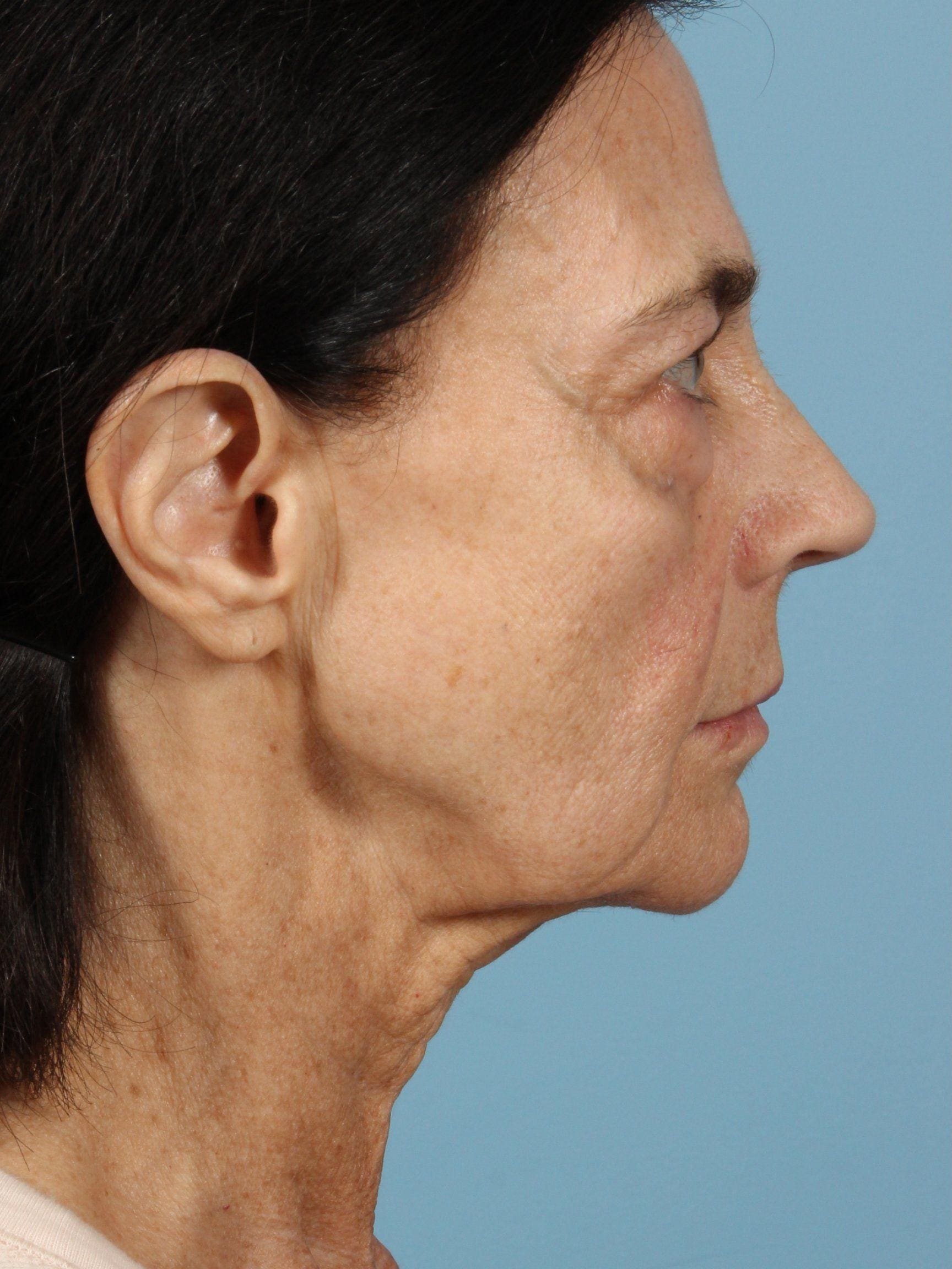 Facelift Patient Photo - Case 15397 - before view-1
