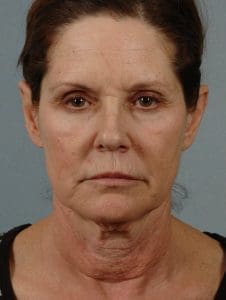 Facelift - Case 15405 - Before