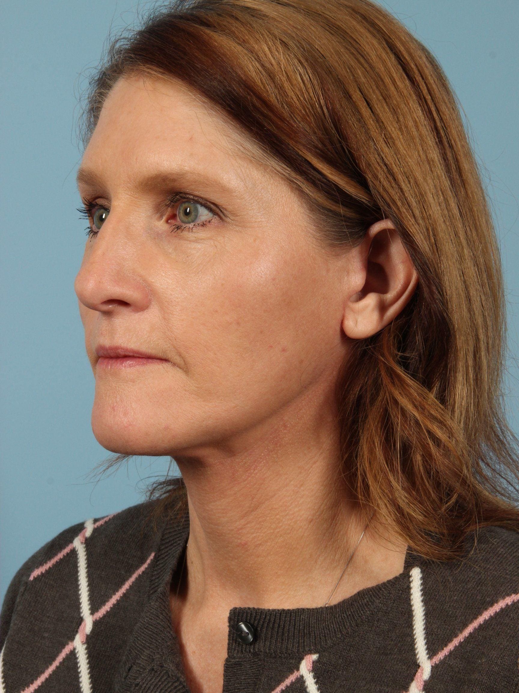 Facelift Patient Photo - Case 15415 - after view-2