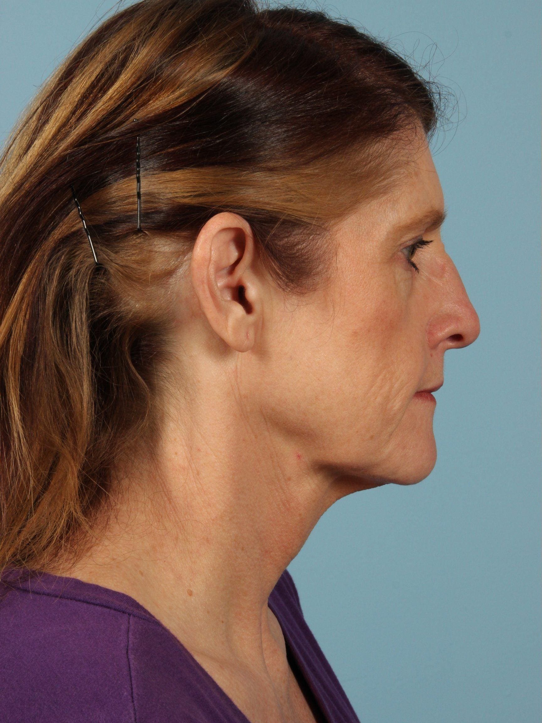 Facelift Patient Photo - Case 15415 - before view-1