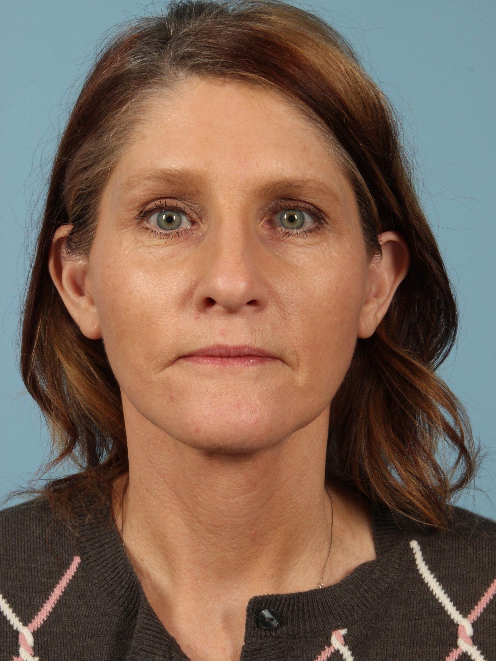 Facelift Patient Photo - Case 15415 - after view