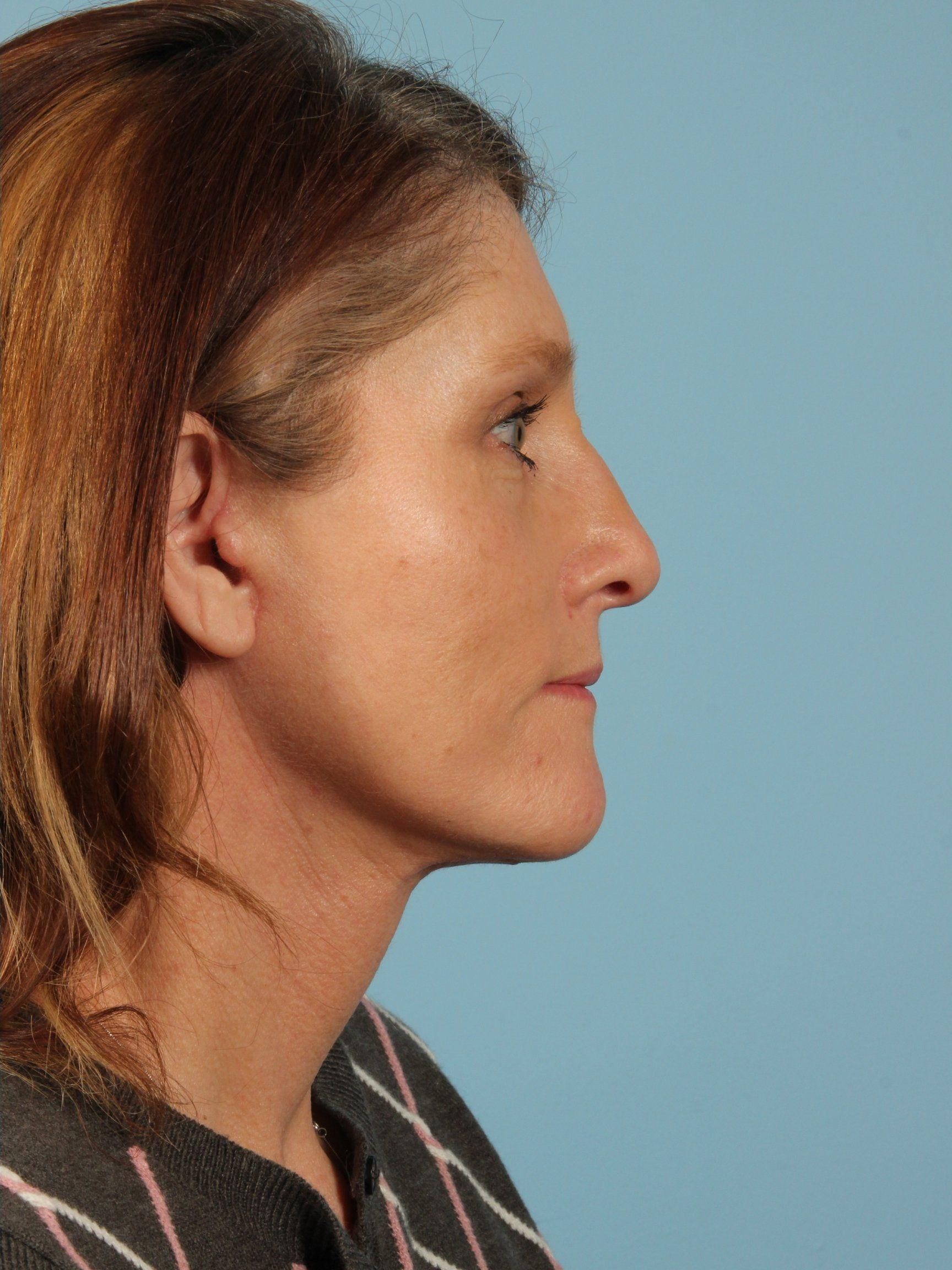 Facelift Patient Photo - Case 15415 - after view-1