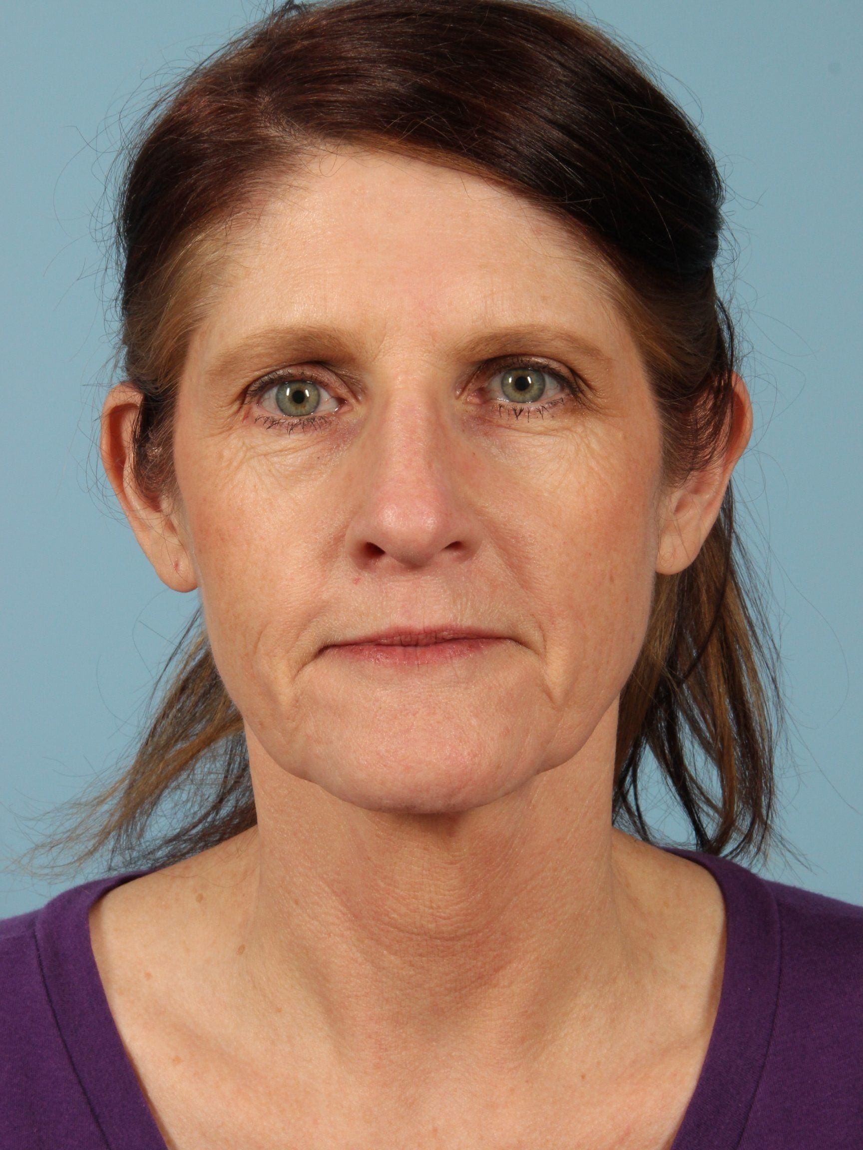 Facelift Patient Photo - Case 15415 - before view-