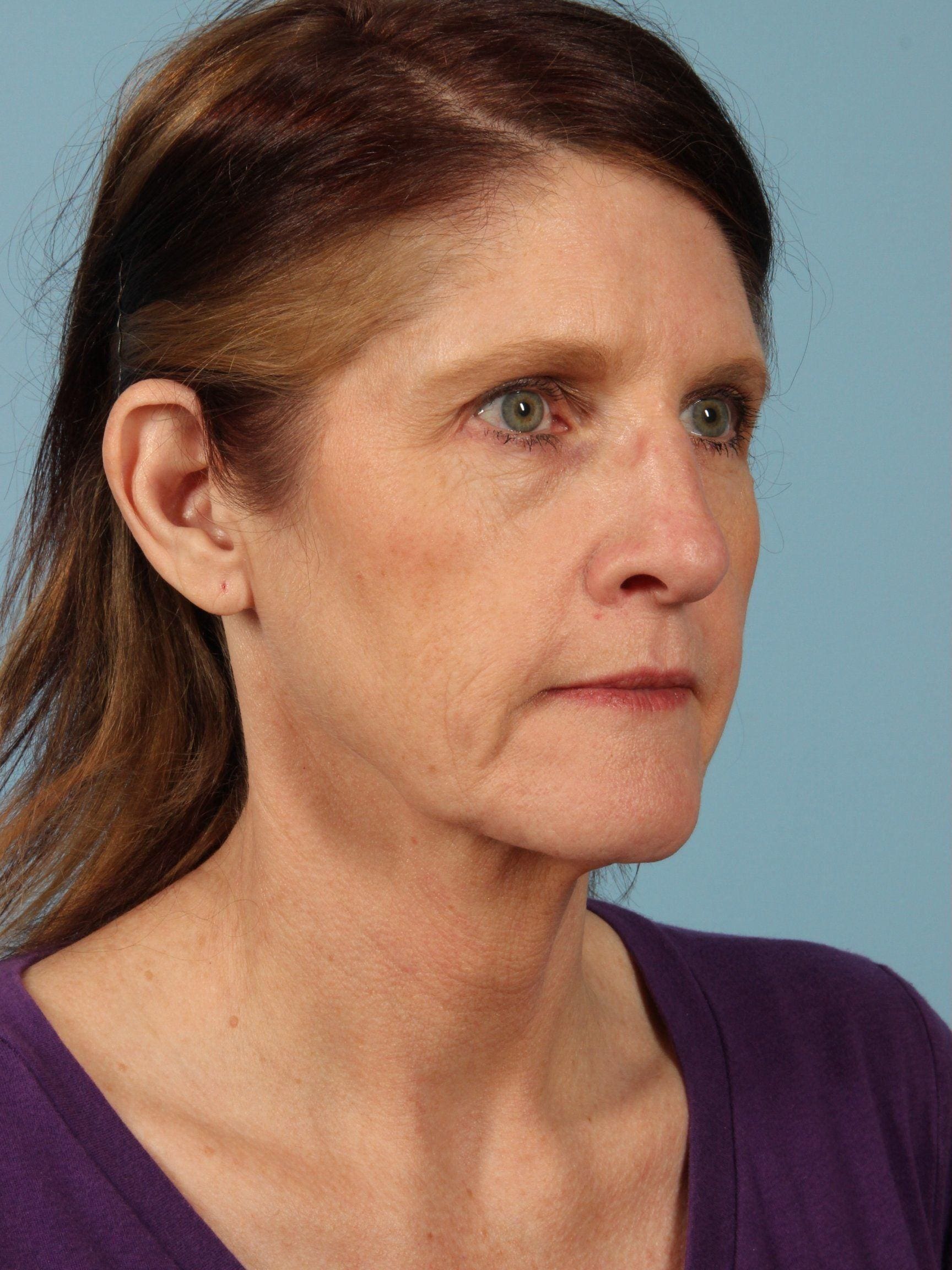 Facelift Patient Photo - Case 15415 - before view-3