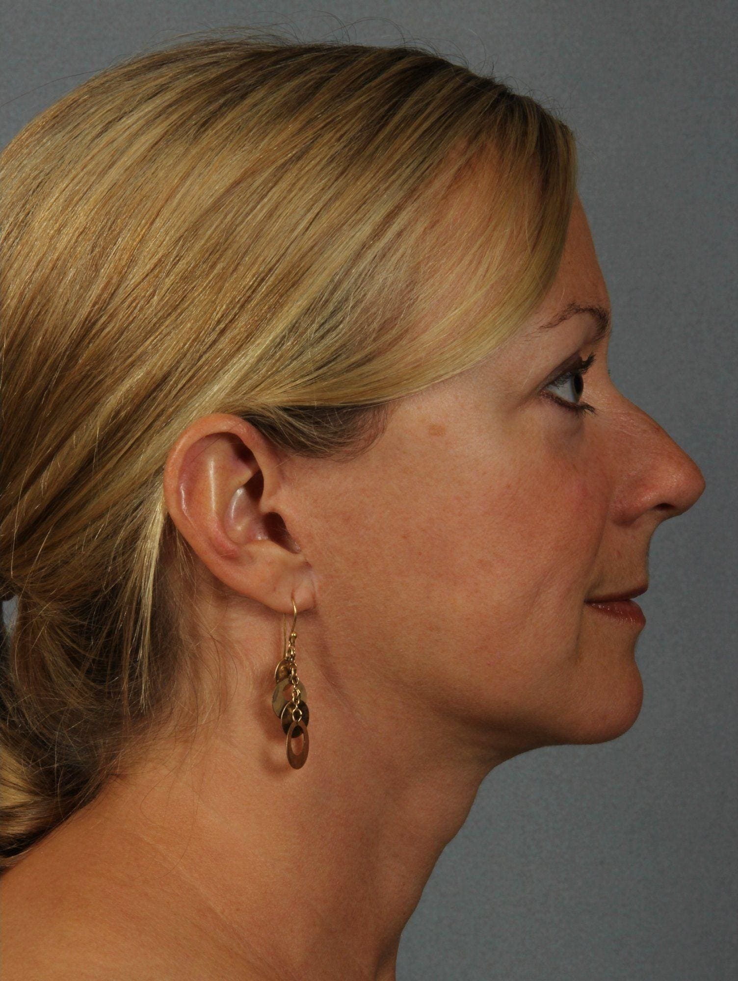 Facelift Patient Photo - Case 15426 - after view-2