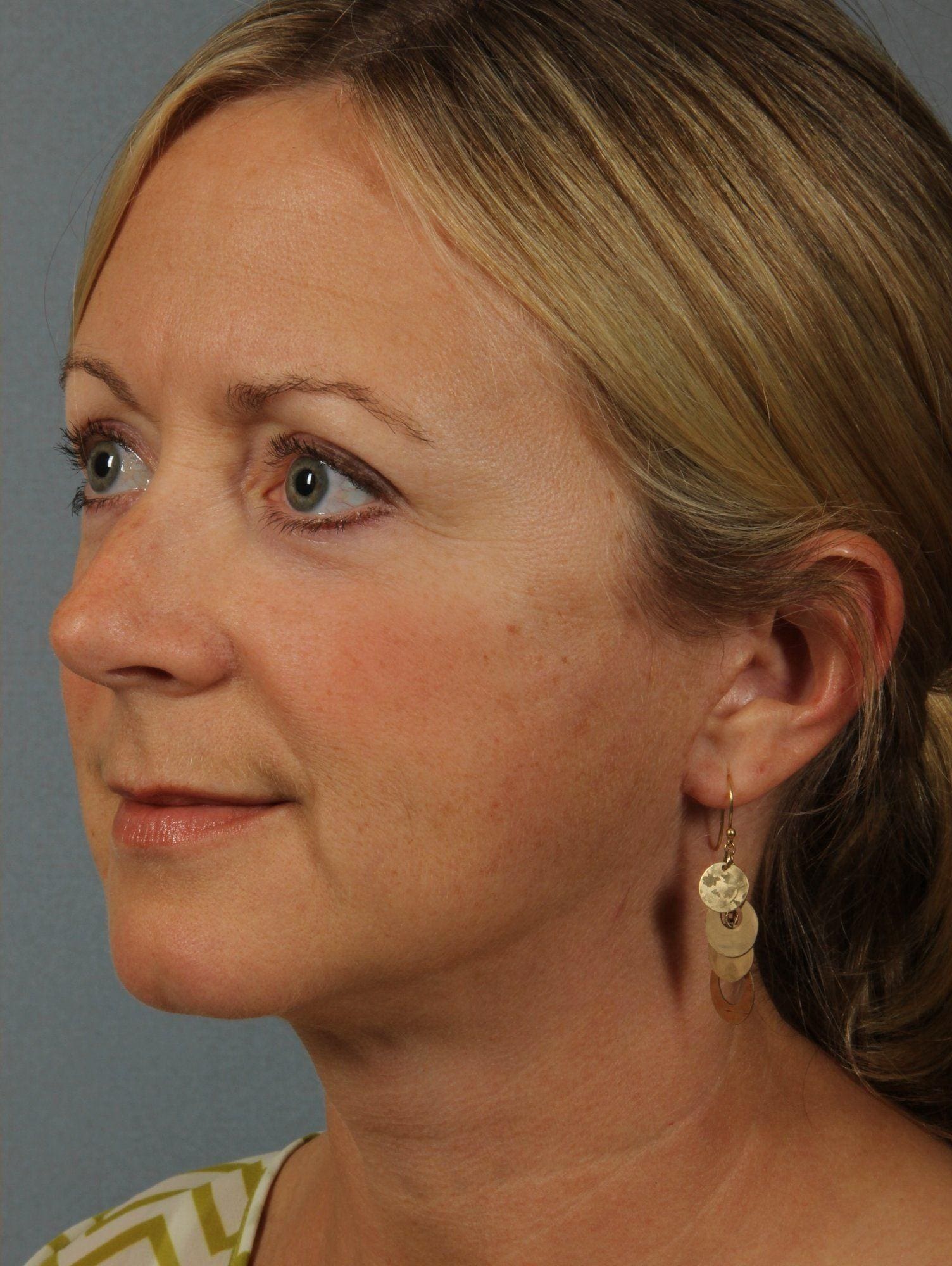 Facelift Patient Photo - Case 15426 - after view-3