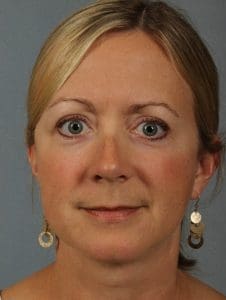 Facelift - Case 15426 - After