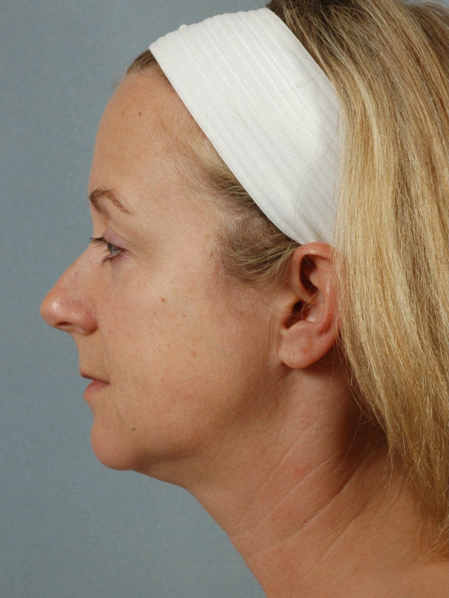 Facelift Patient Photo - Case 15426 - before view-1