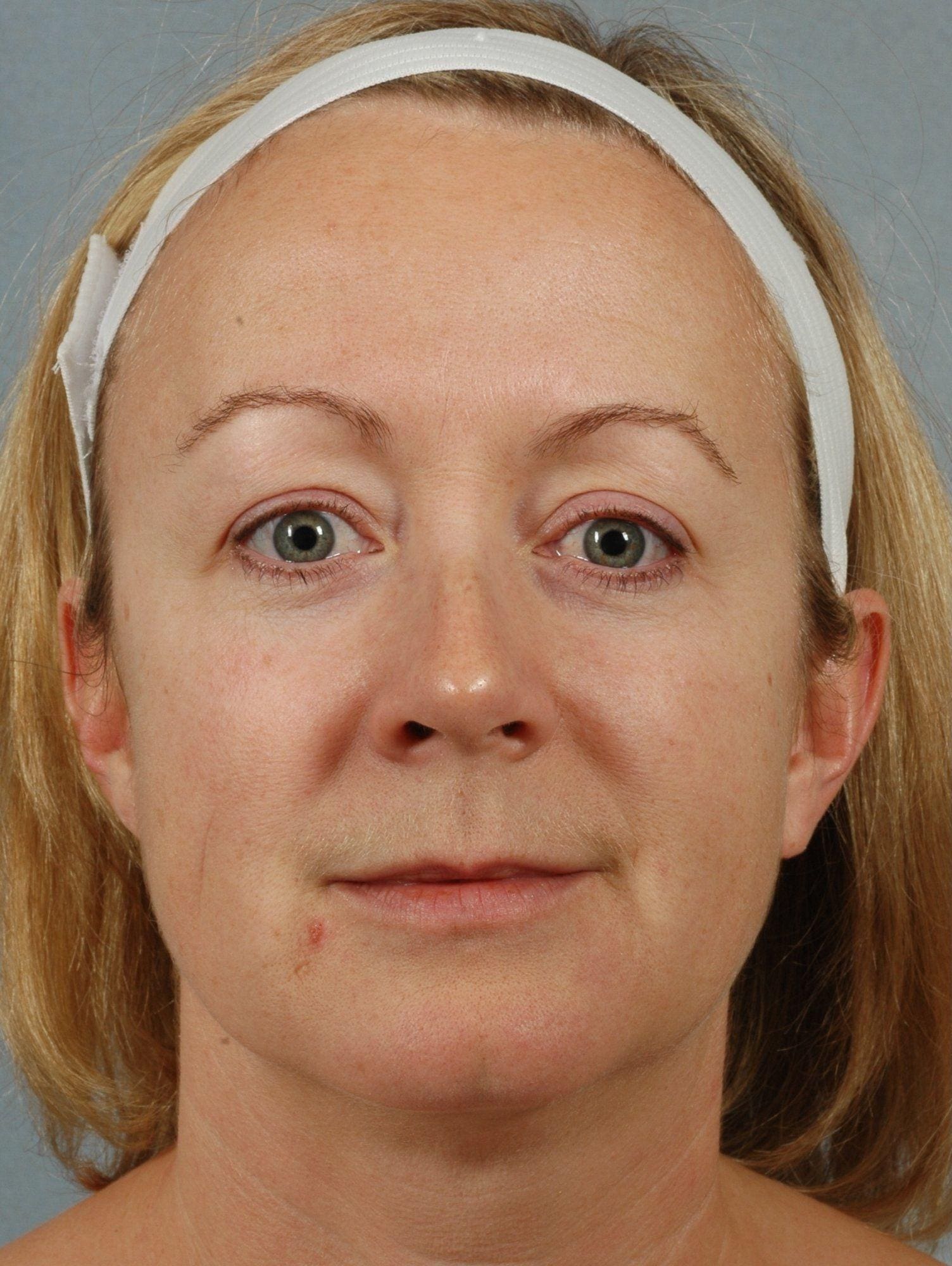 Facelift Patient Photo - Case 15426 - before view-