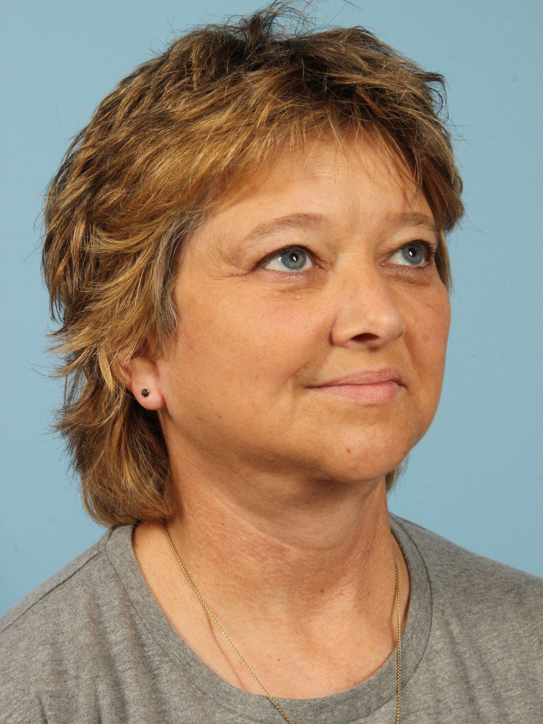 Facelift Patient Photo - Case 15450 - after view-4