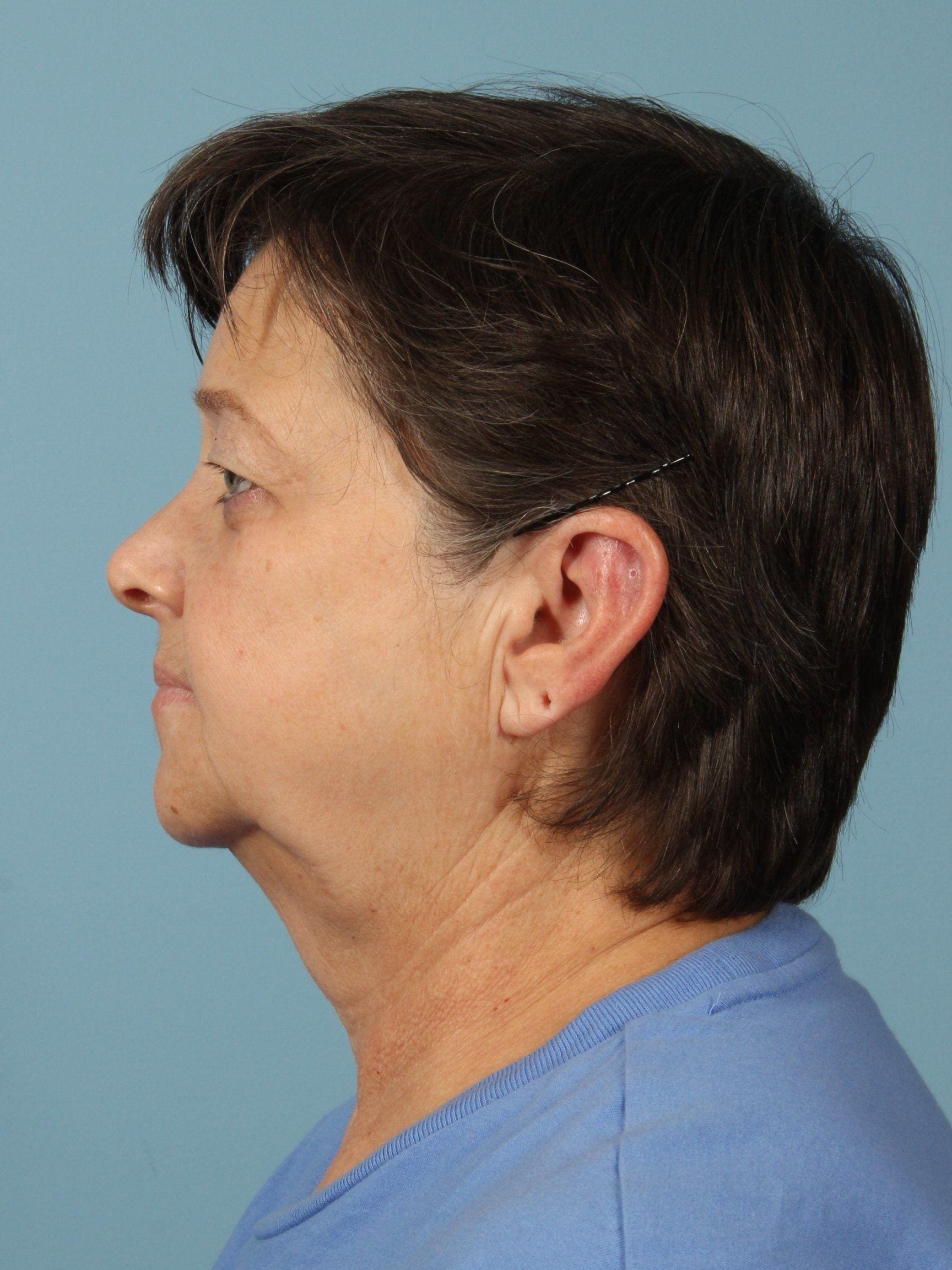 Facelift Patient Photo - Case 15450 - before view-1