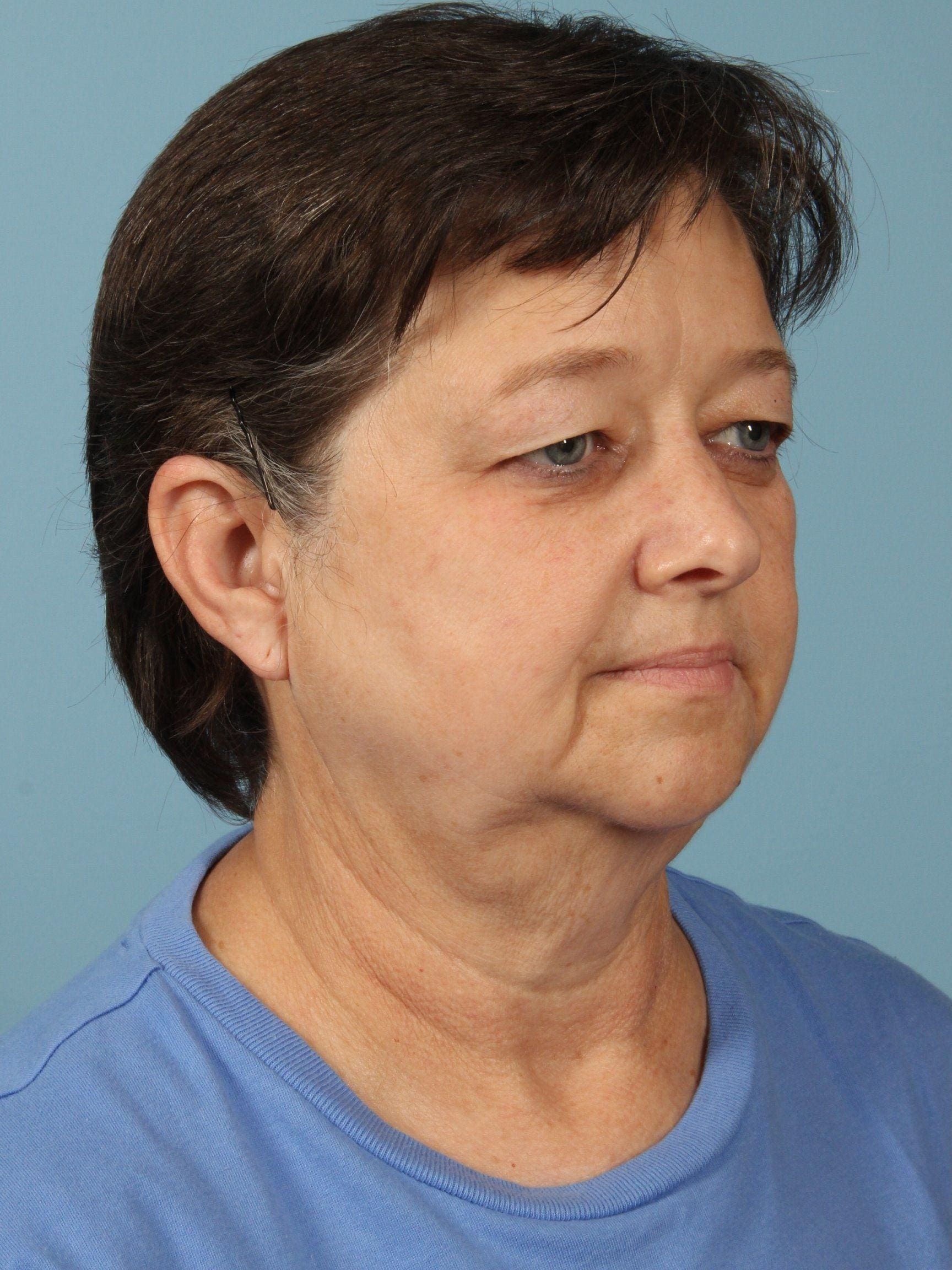 Facelift Patient Photo - Case 15450 - before view-4