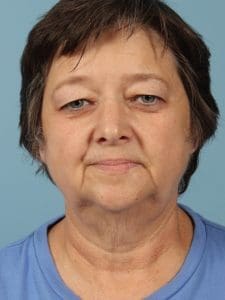 Facelift - Case 15450 - Before