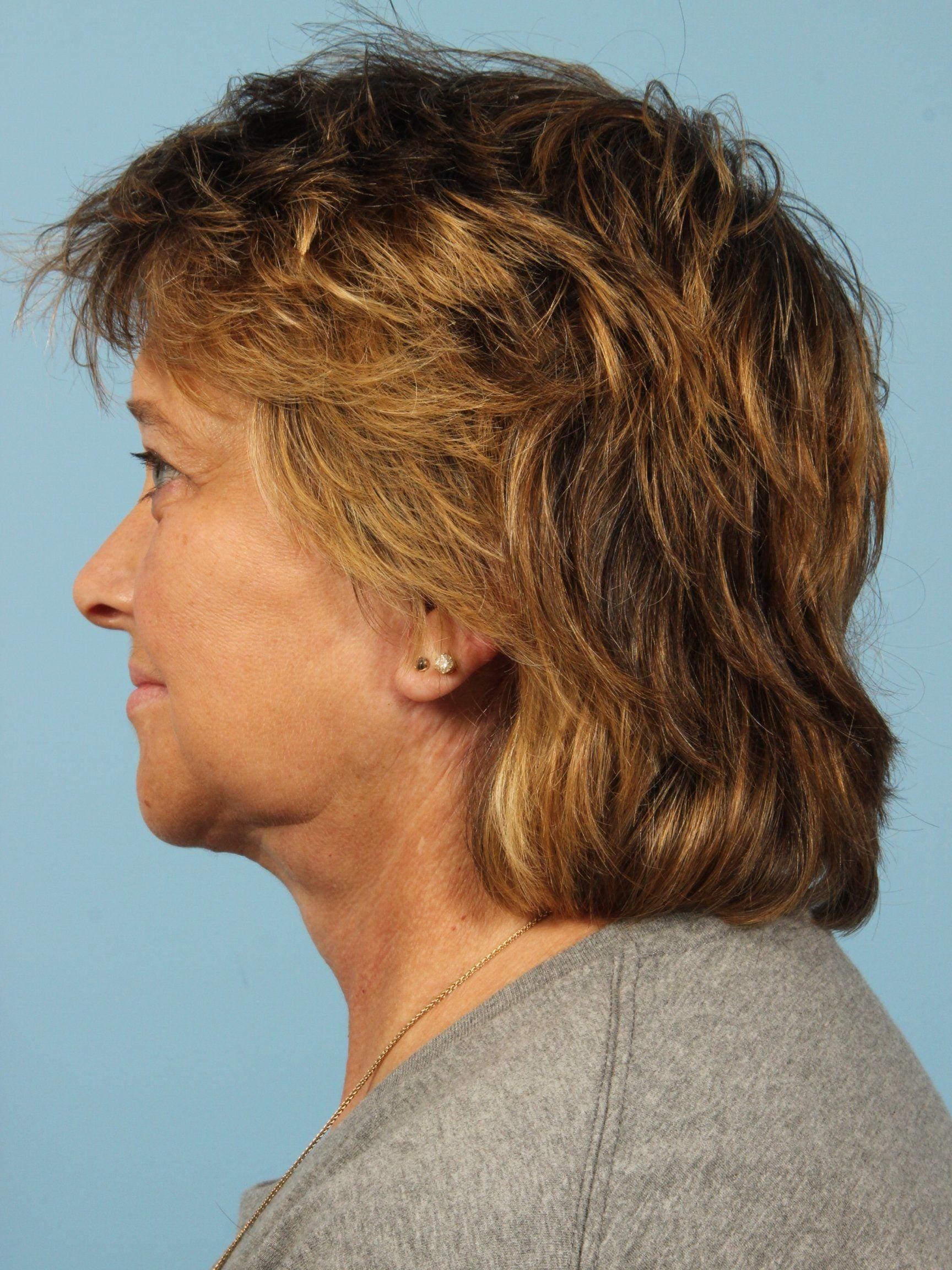 Facelift Patient Photo - Case 15450 - after view-1