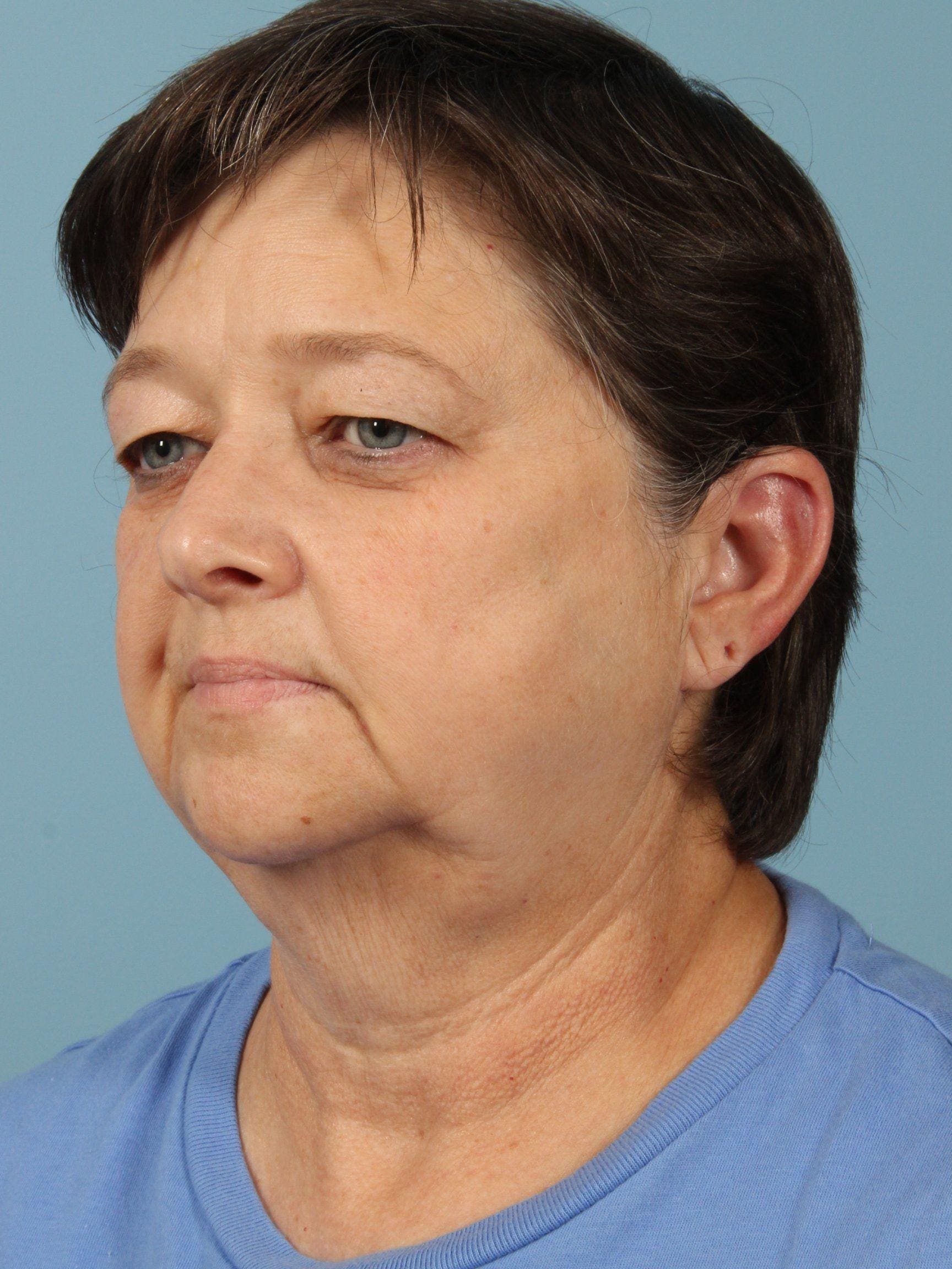 Facelift Patient Photo - Case 15450 - before view-3