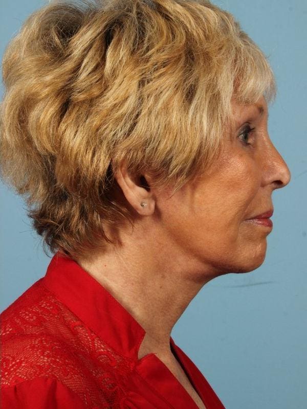 Facelift Patient Photo - Case 15460 - after view-2
