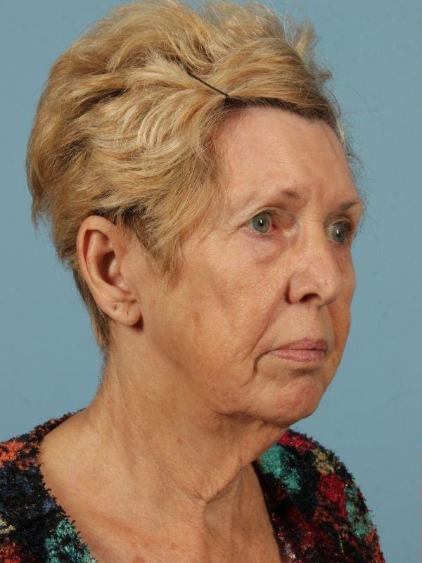 Facelift Patient Photo - Case 15460 - before view-4