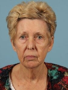 Facelift - Case 15460 - Before