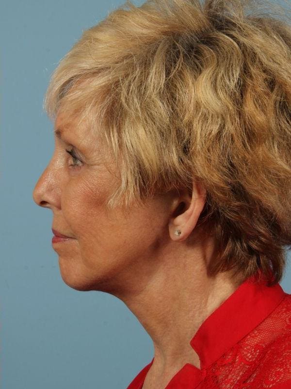 Facelift Patient Photo - Case 15460 - after view-1