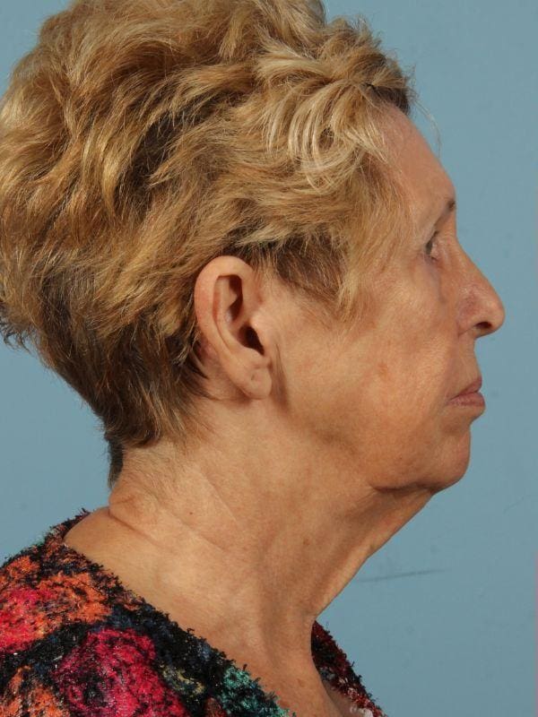 Facelift Patient Photo - Case 15460 - before view-2