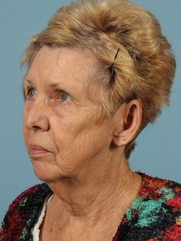 Facelift Patient Photo - Case 15460 - before view-3
