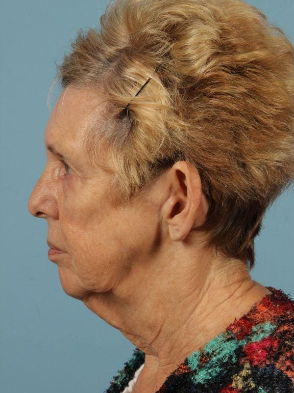 Facelift Patient Photo - Case 15460 - before view-1