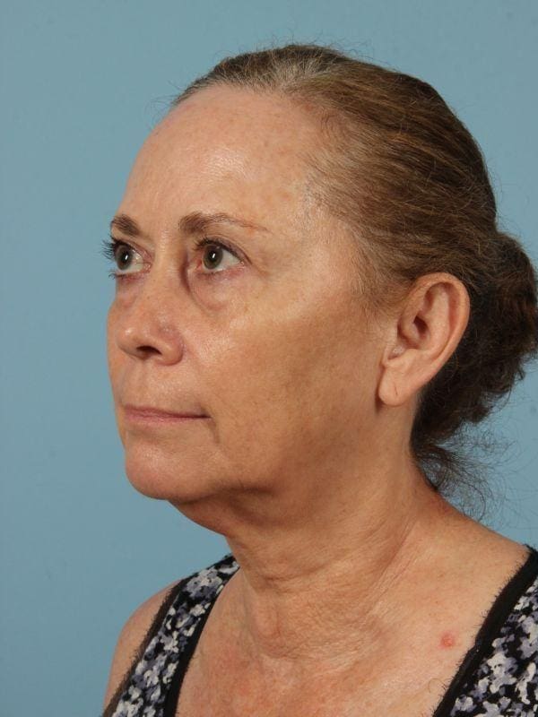 Facelift Patient Photo - Case 15472 - before view-2