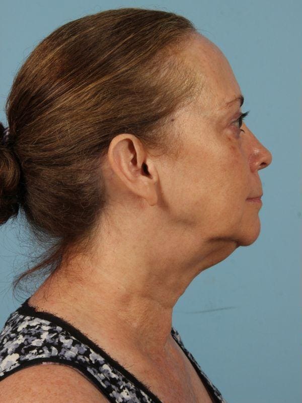 Facelift Patient Photo - Case 15472 - before view-1