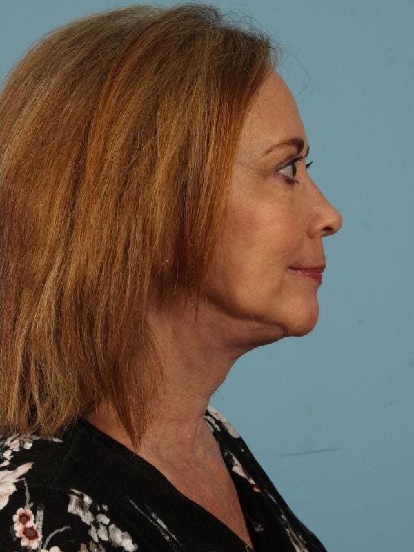 Facelift Patient Photo - Case 15472 - after view-1