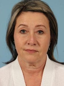 Facelift - Case 15482 - Before