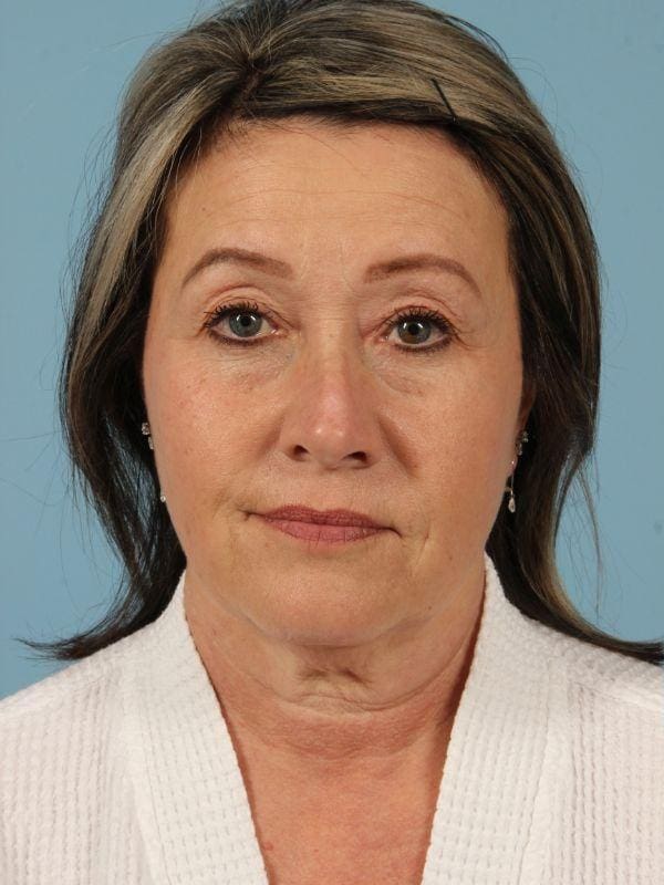 Facelift Patient Photo - Case 15482 - before view-