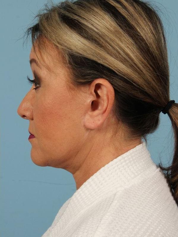 Facelift Patient Photo - Case 15482 - after view-1