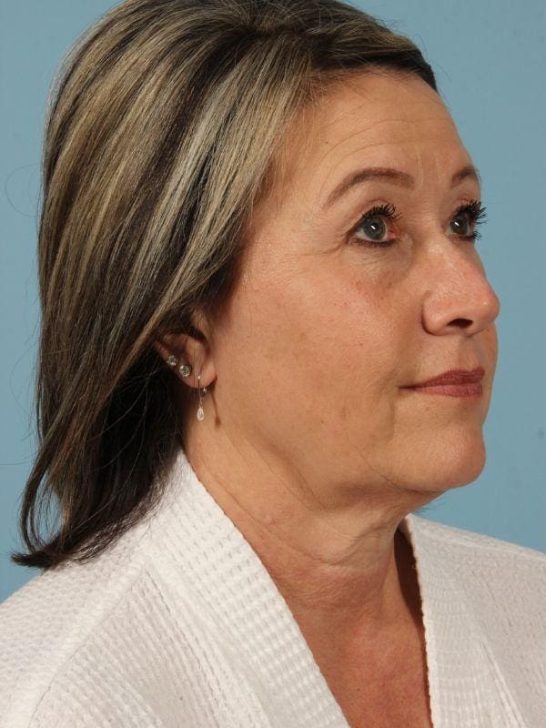 Facelift Patient Photo - Case 15482 - before view-3
