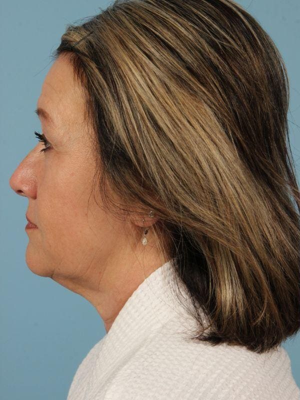 Facelift Patient Photo - Case 15482 - before view-1