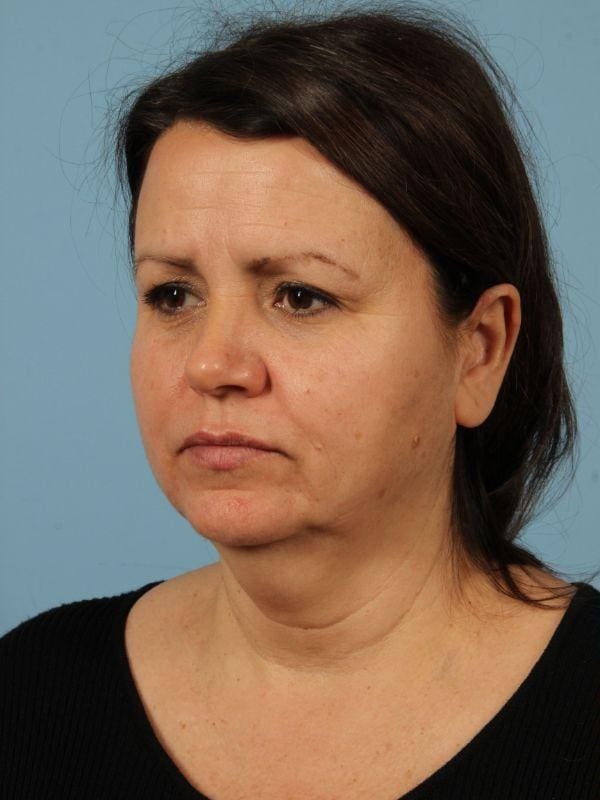 Facelift Patient Photo - Case 15492 - before view-1