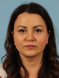 Facelift - Case 15492 - After