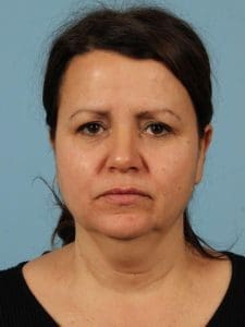 Facelift - Case 15492 - Before