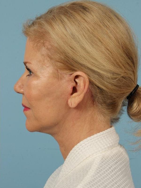 Facelift Patient Photo - Case 15498 - after view-1