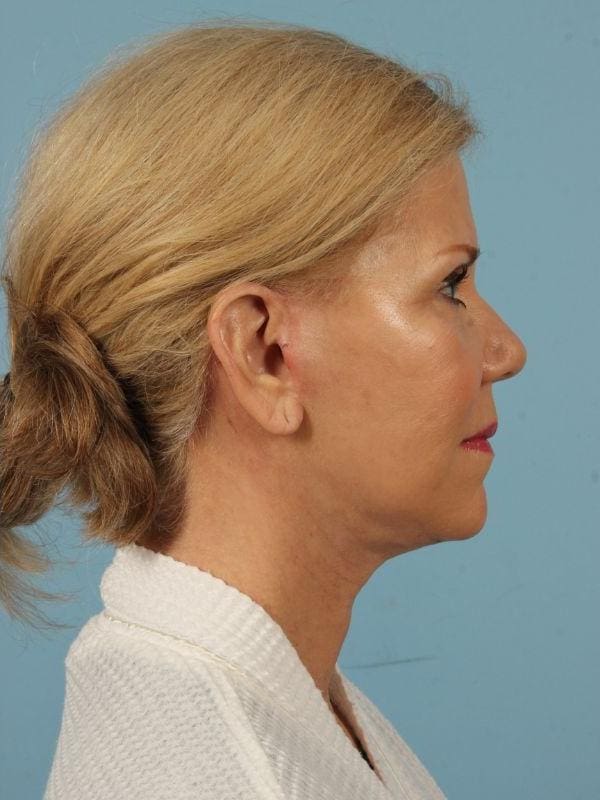 Facelift Patient Photo - Case 15498 - after view-2