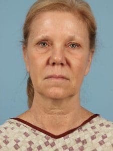 Facelift - Case 15498 - Before