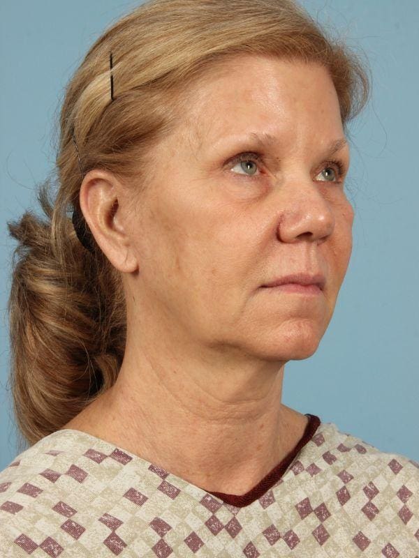 Facelift Patient Photo - Case 15498 - before view-4